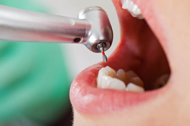 Best Emergency Wisdom Tooth Extraction in Lindale, GA